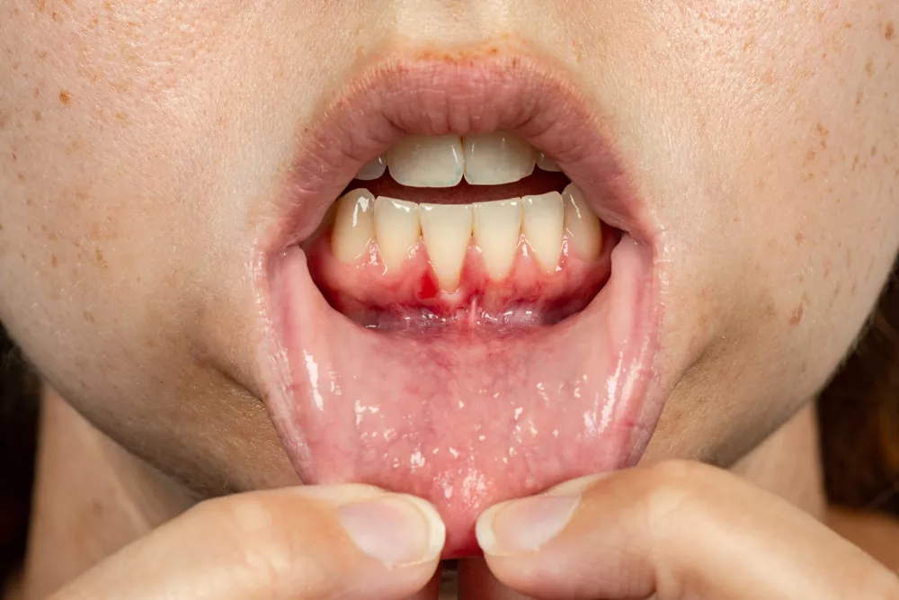 BelleDente revitalizes gums 6 1745490777 Looking for Symptoms of Gum Disease