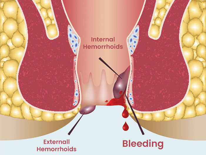Relieflogix Hemorrhoid Spray image Relieflogix Hemorrhoid Spray
