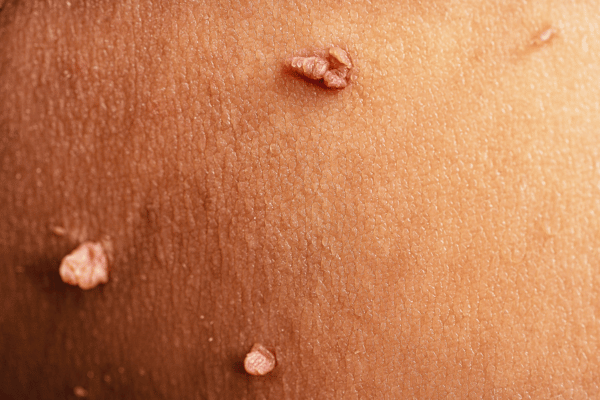 BeeRx Mole Removal Spray 29 1741067897 c1