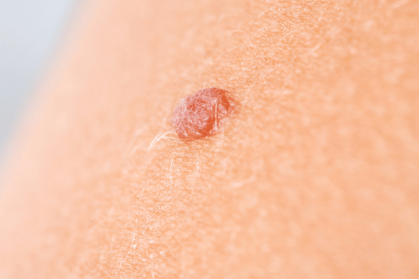 BeeRx Mole Removal Spray 31 1741067907 c3