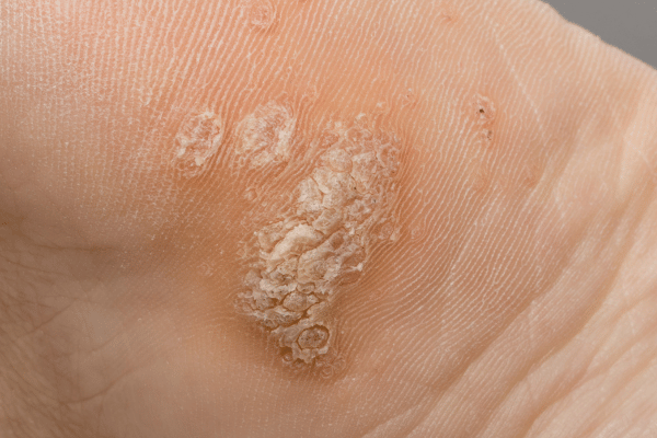 BeeRx Mole Removal Spray 33 1741067916 c5