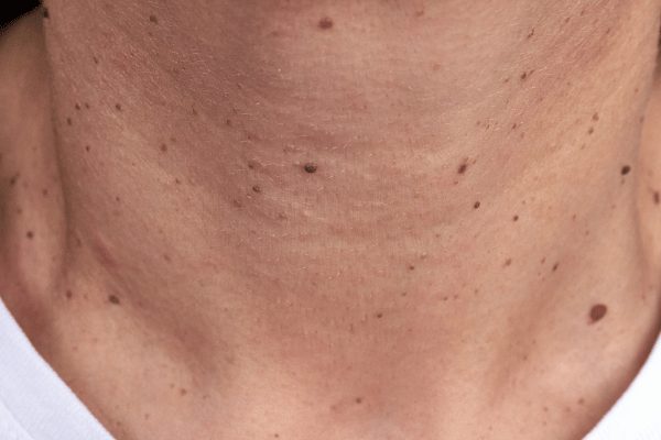 BeeRx Mole Removal Spray 34 1741067921 c6